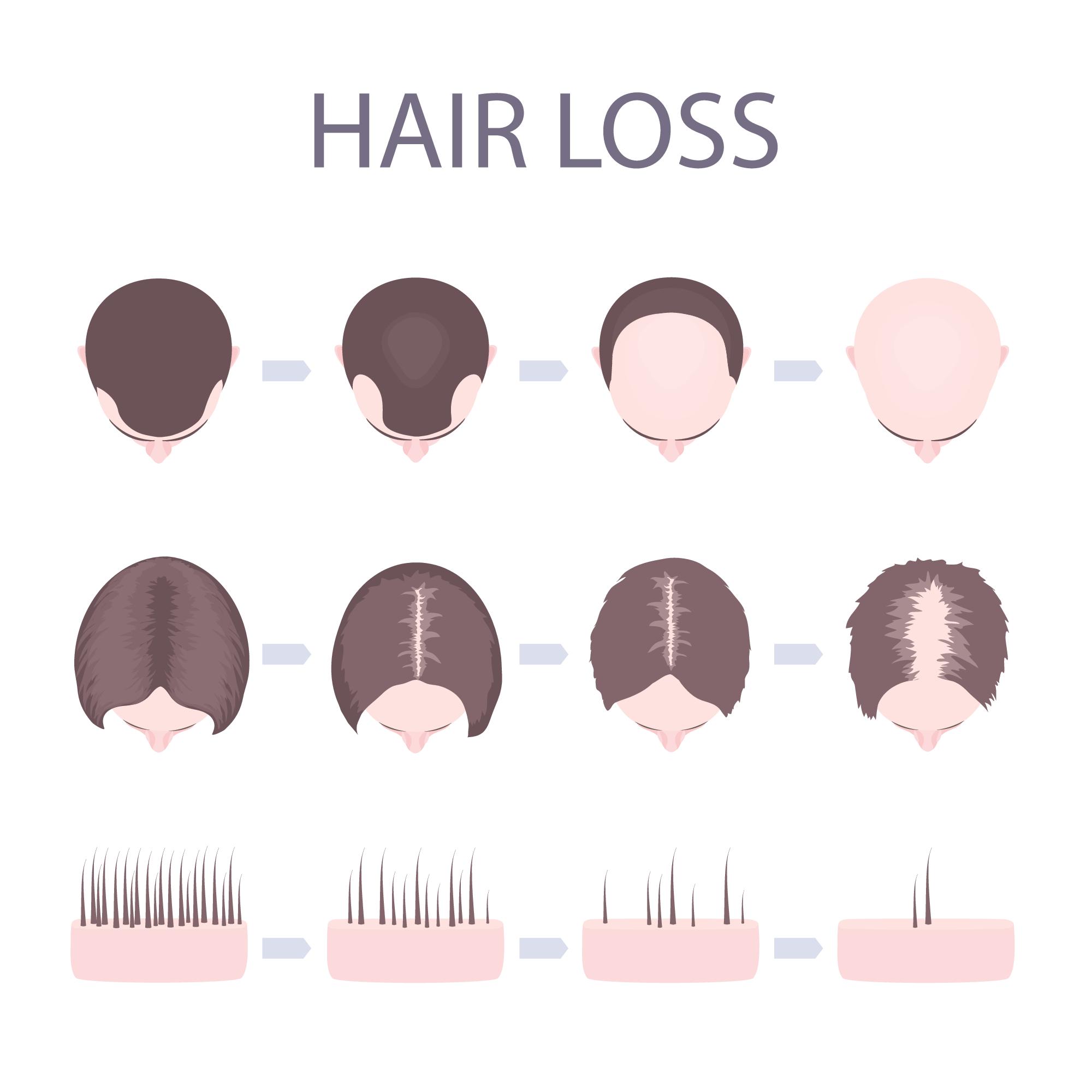 hair-loss-types