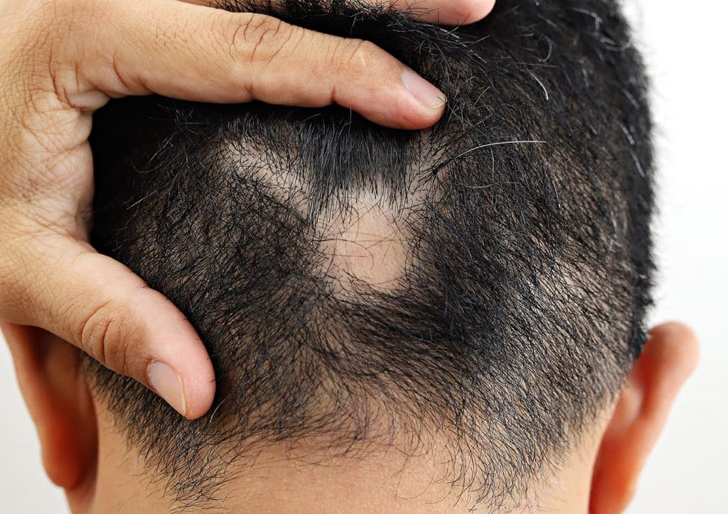 Genetic Hair Loss Treatment  Svenson