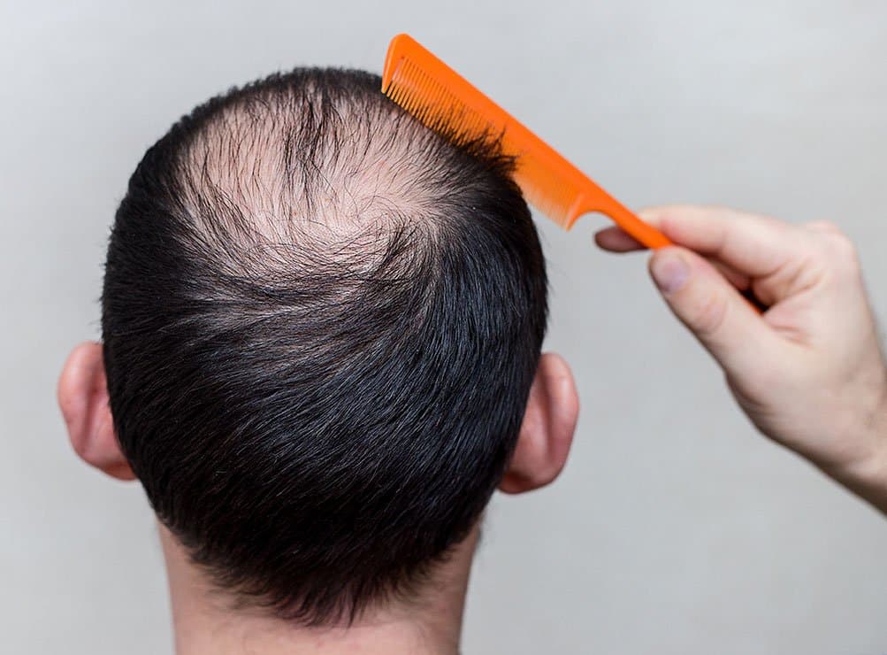 How To Deal With Genetic Hair loss  Rejuvenate Hair